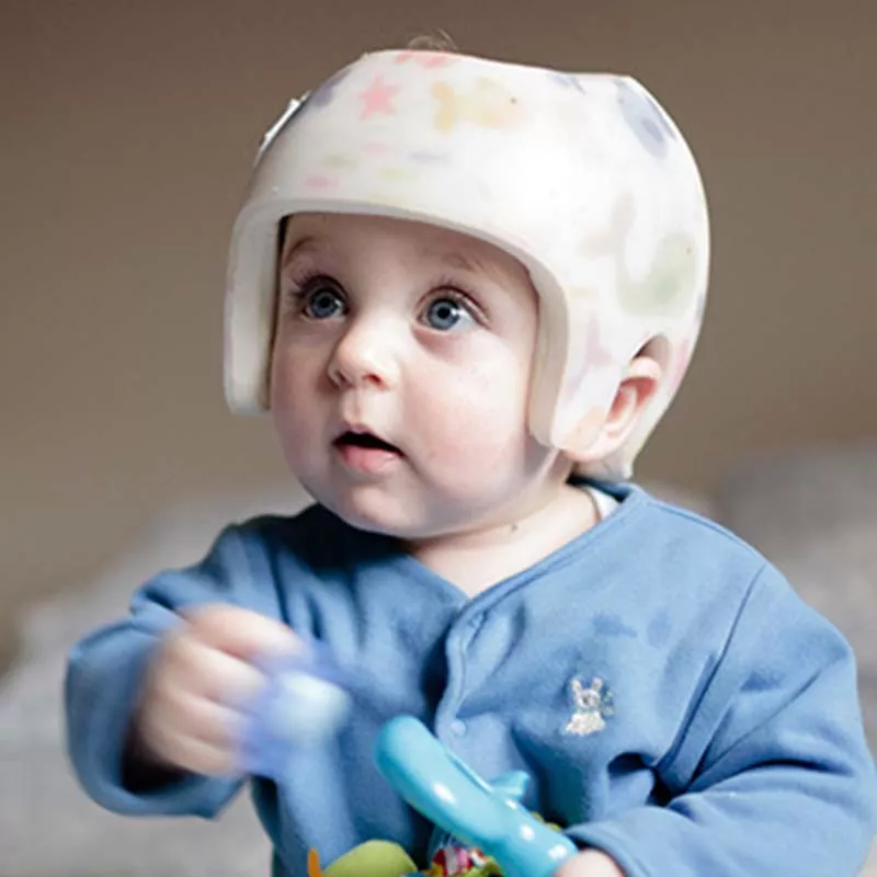 Baby with plagiocephaly